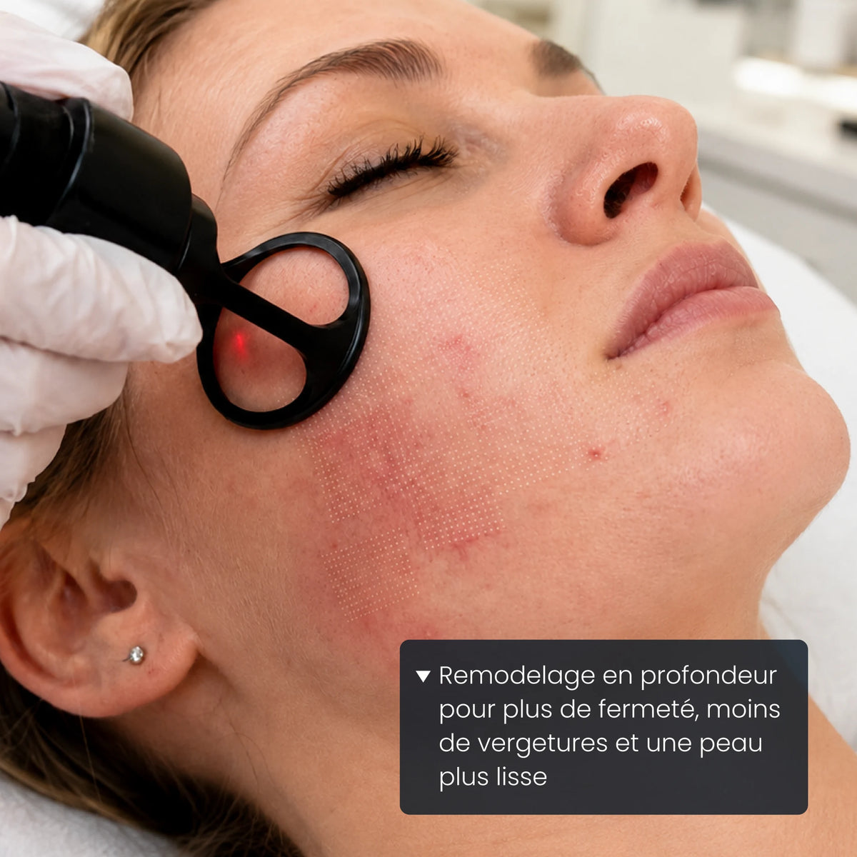 Remodelage profond pour la fermeté, les vergetures et la texture corporelle