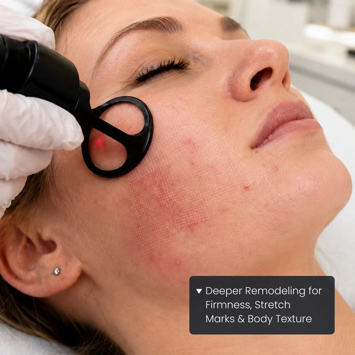 Farexo Fractional CO₂ RF Microneedling System - product detail 5