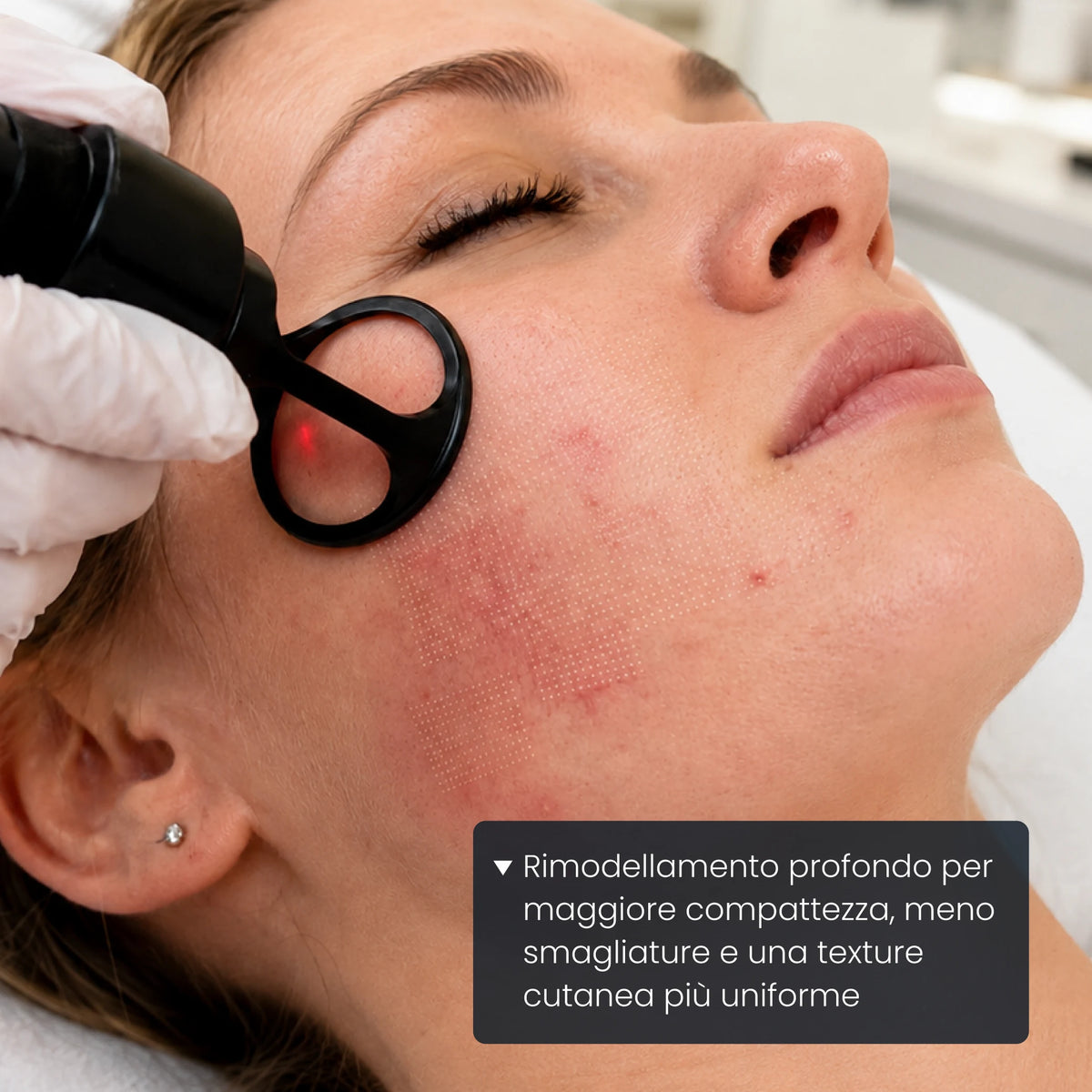Rimodellamento profondo per compattezza, smagliature e grana della pelle del corpo
